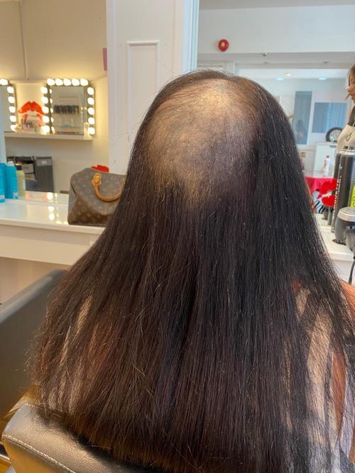 Hair Replacement Consultation & Treatment