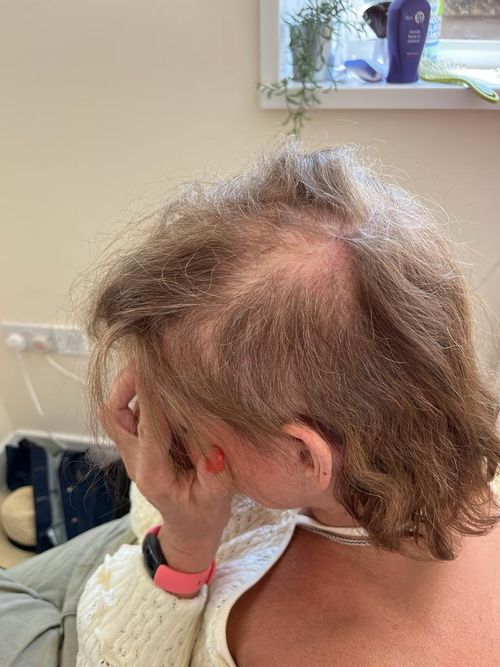 Hair Replacement Consultation & Treatment