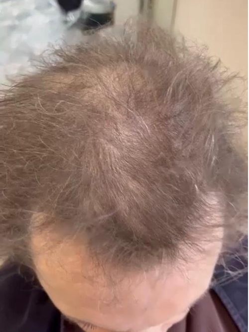 Hair Replacement Consultation & Treatment