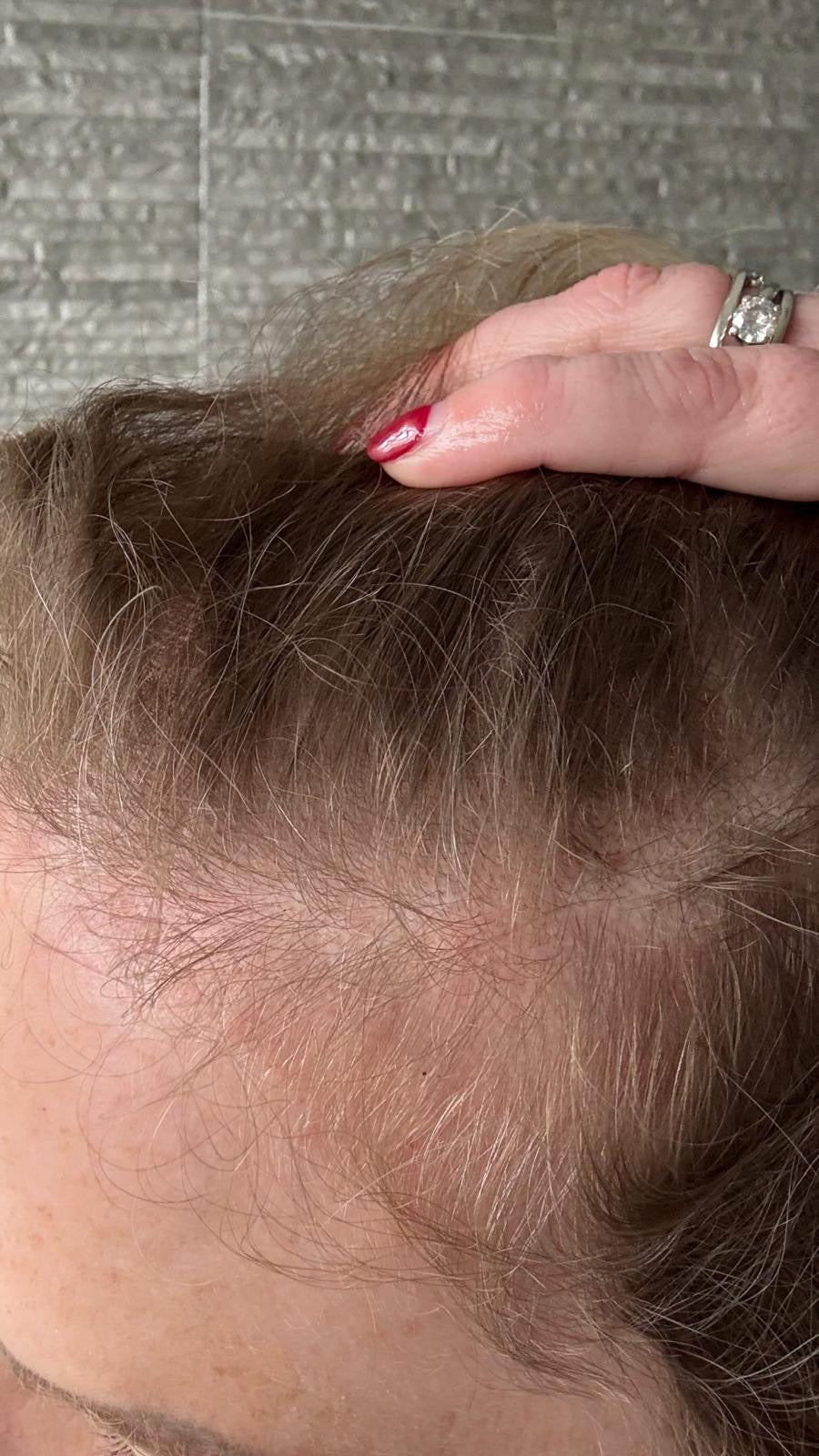 Scalp Renewal Therapy – Advanced Regrowth Treatment (Single Treatment)