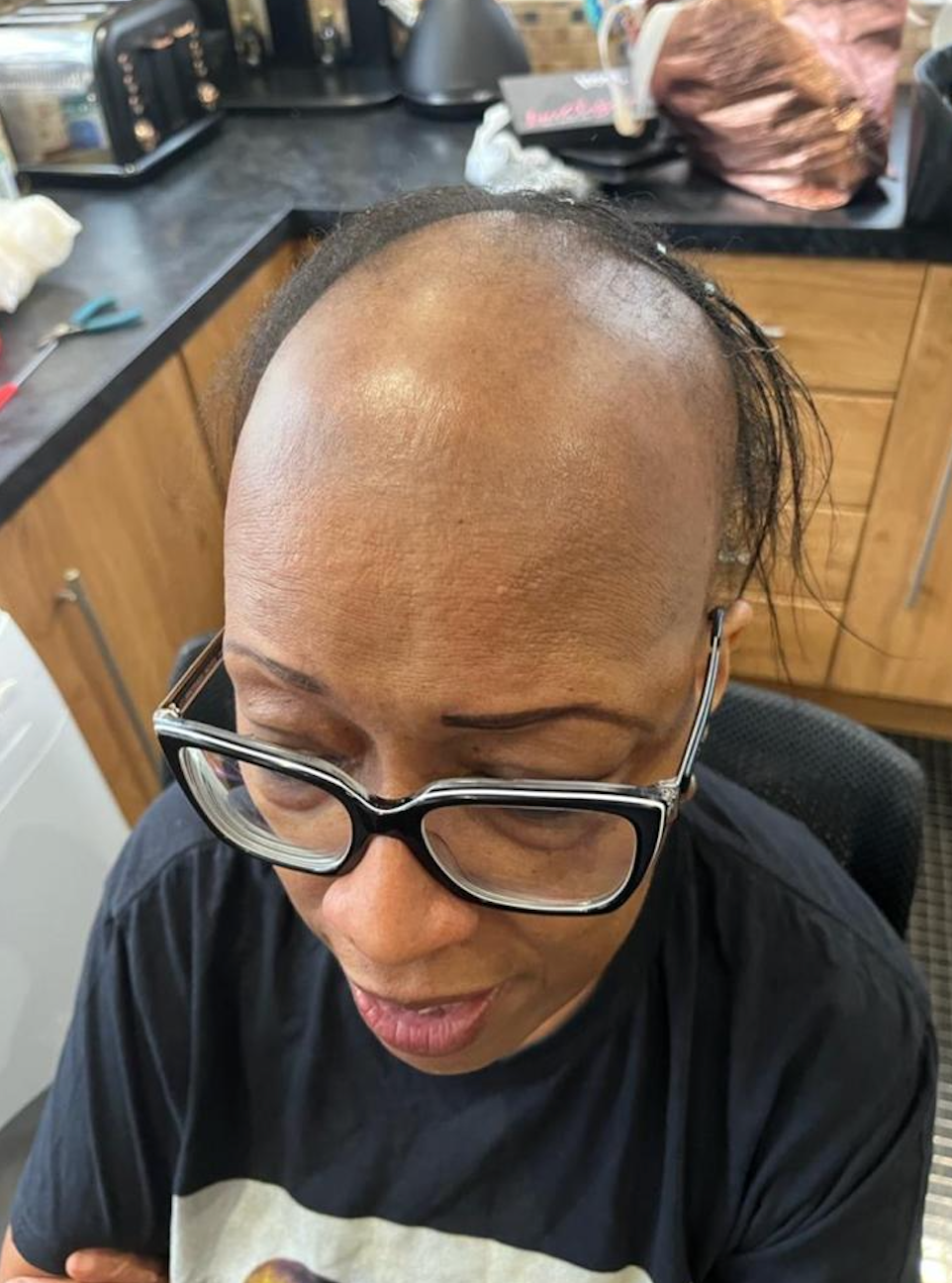 Hair Replacement Consultation & Treatment