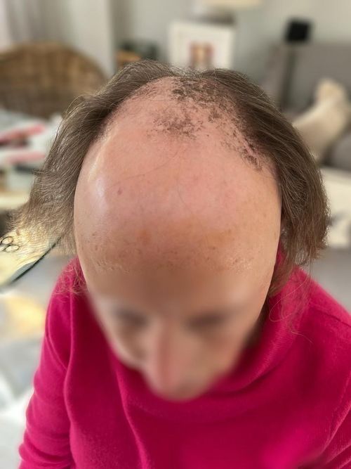 Hair replacement maintenance