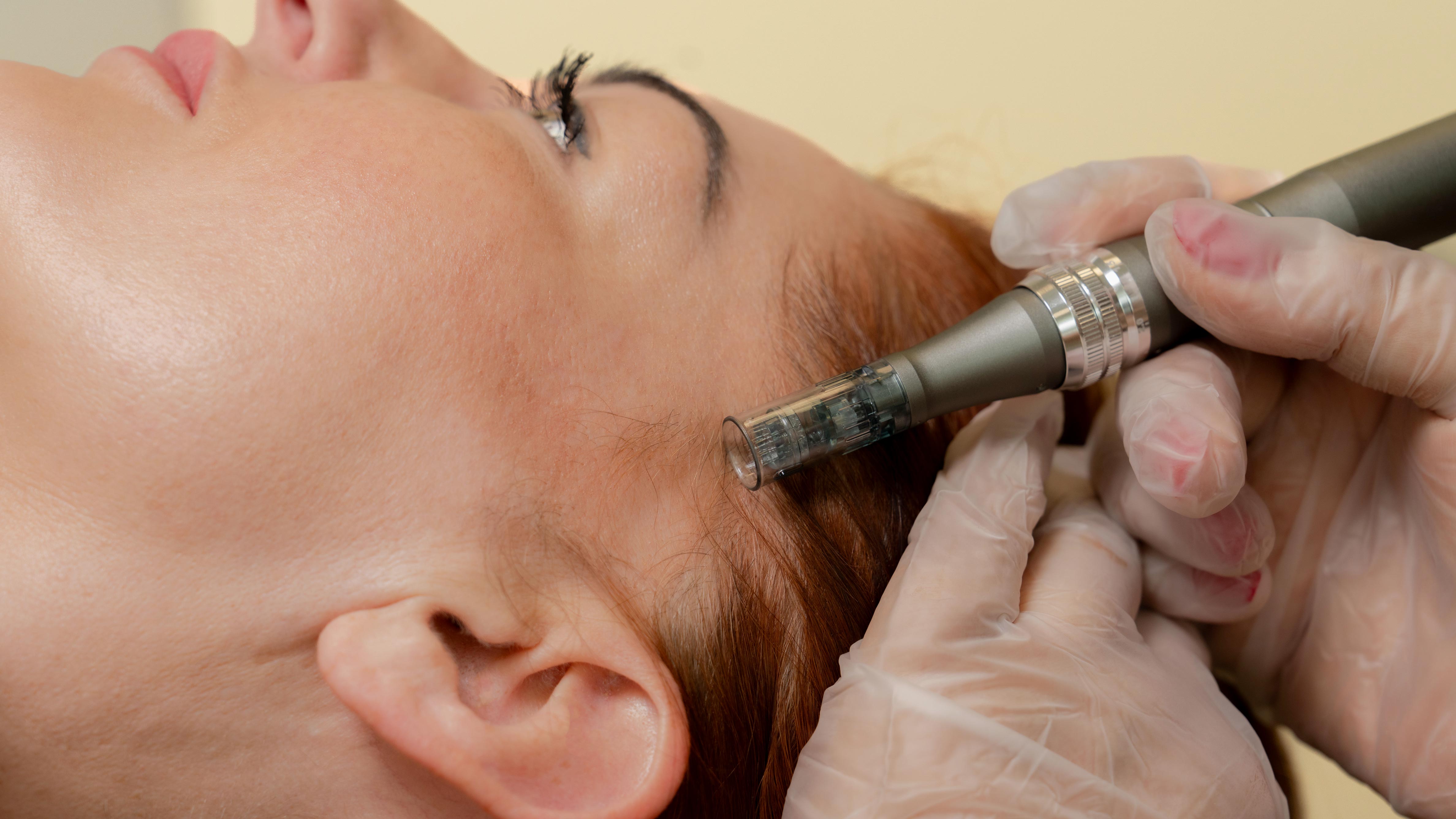 Scalp Micro-needling consultation and treatment